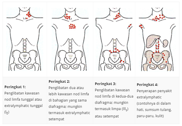 Apa Itu Kanser Limfoma? Ini Perkara Yang Korang Perlu Ambil Tahu