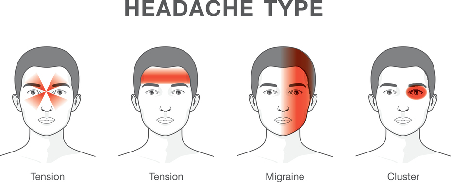 Kenapa Sakit Kepala Sebelah Kiri - Info Kesehatan