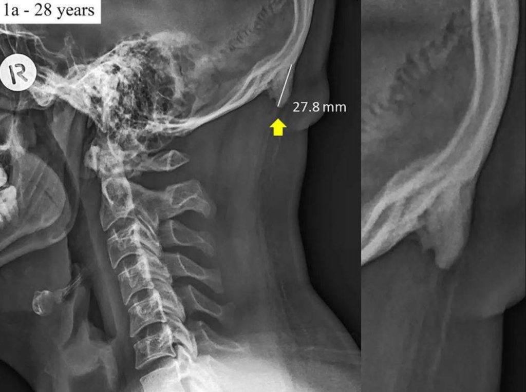 Fakta Sains Buktikan  Bila Asyik Tengok Telefon, Akan  Tumbuh Tulang Tidak Normal Dalam Tempurung Kepala