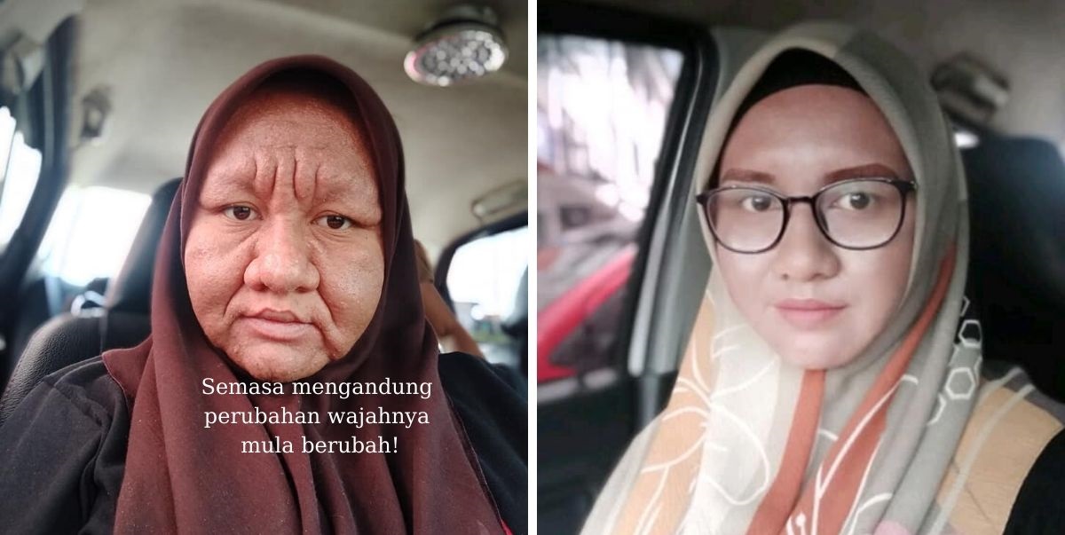 Muka Berubah Jadi Tua Saat Mengandung, Perkongsian Wanita Ini Jadi Viral