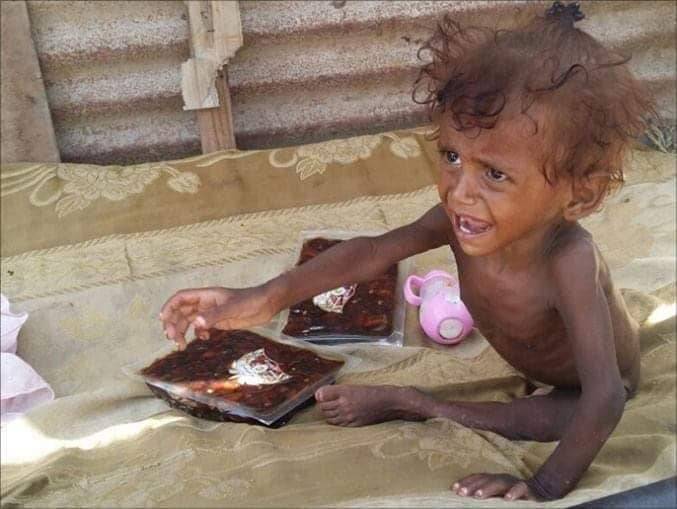 Kem Pelarian Jadi “Kubur Besar”, 7 Juta Kanak-Kanak Yaman Tidur Kelaparan Setiap Malam