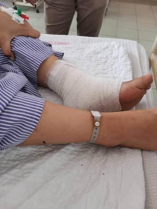 Ngeri! Tangan Wanita Digigit Anjing Cedera Parah, Mungkin Tidak Berfungsi Seperti Sediakala