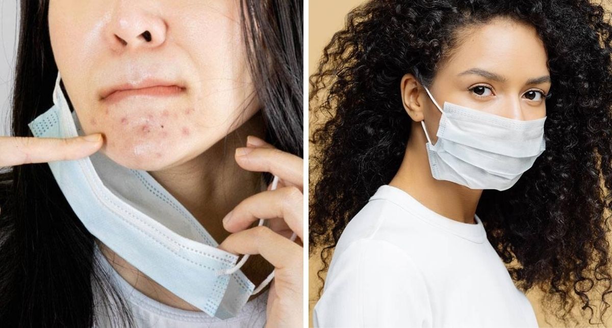 Apa Kaitan Face Mask Dan Jerawat, 5 Nasihat Dari Doktor Ini Elak ‘Maskne’