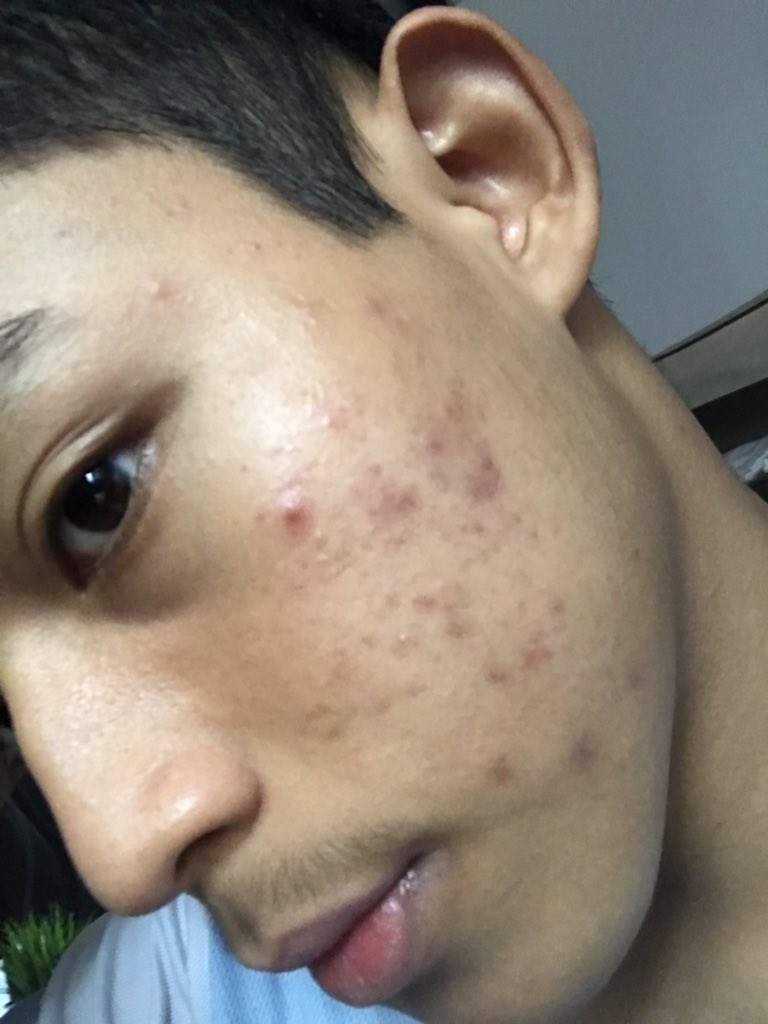 Masalah Breakout, Lelaki Ini Kongsi Rutin Skincare Pulihkan Kulit Wajah