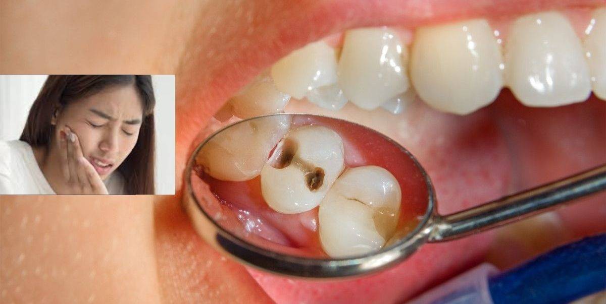 Ini 7 Punca Kenapa Gigi Berlubang, Sakitnya Boleh Buat