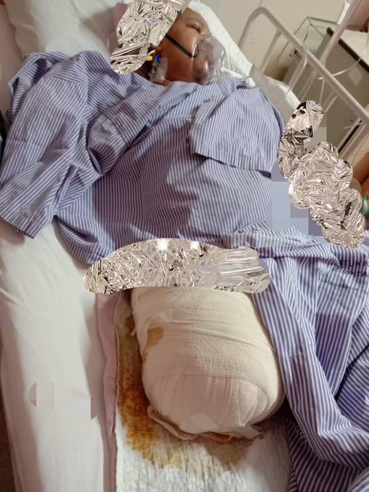 Setahun Selepas Tangan Dipotong Akibat Terlibat Kemalangan Ngeri, Wanita Redha Kaki Juga Perlu Dibuang