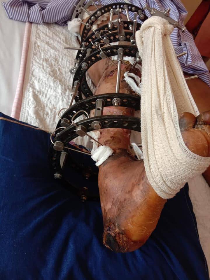 Setahun Selepas Tangan Dipotong Akibat Terlibat Kemalangan Ngeri, Wanita Redha Kaki Juga Perlu Dibuang