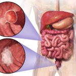 Blausen_0246_ColorectalCancer