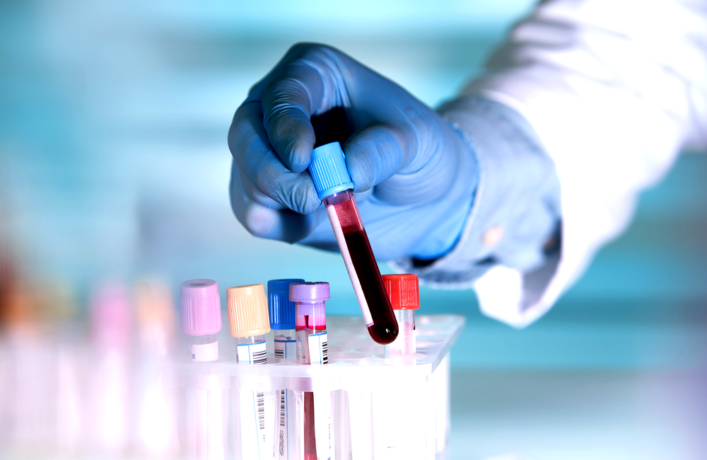Kajian Menjelaskan Kumpulan Darah O Paling Kurang Berisiko Dijangkiti COVID-19