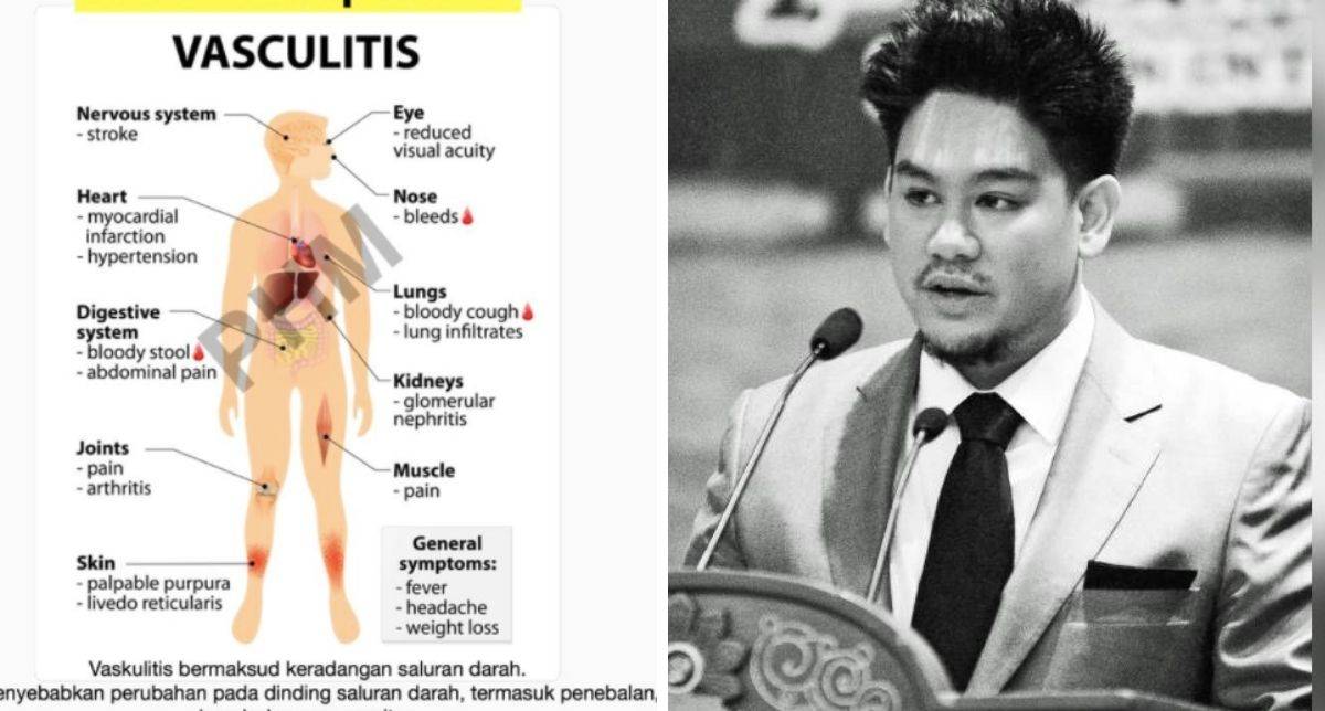 Kenali Penyakit Vaskulitis, Punca Kemangkatan Anak Sultan Brunei