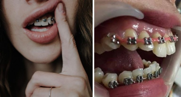 “Jangan Bahayakan Diri”, KKM Kongsi Risiko Pakai ‘Fake Braces’ Yang Semua Kena Tahu