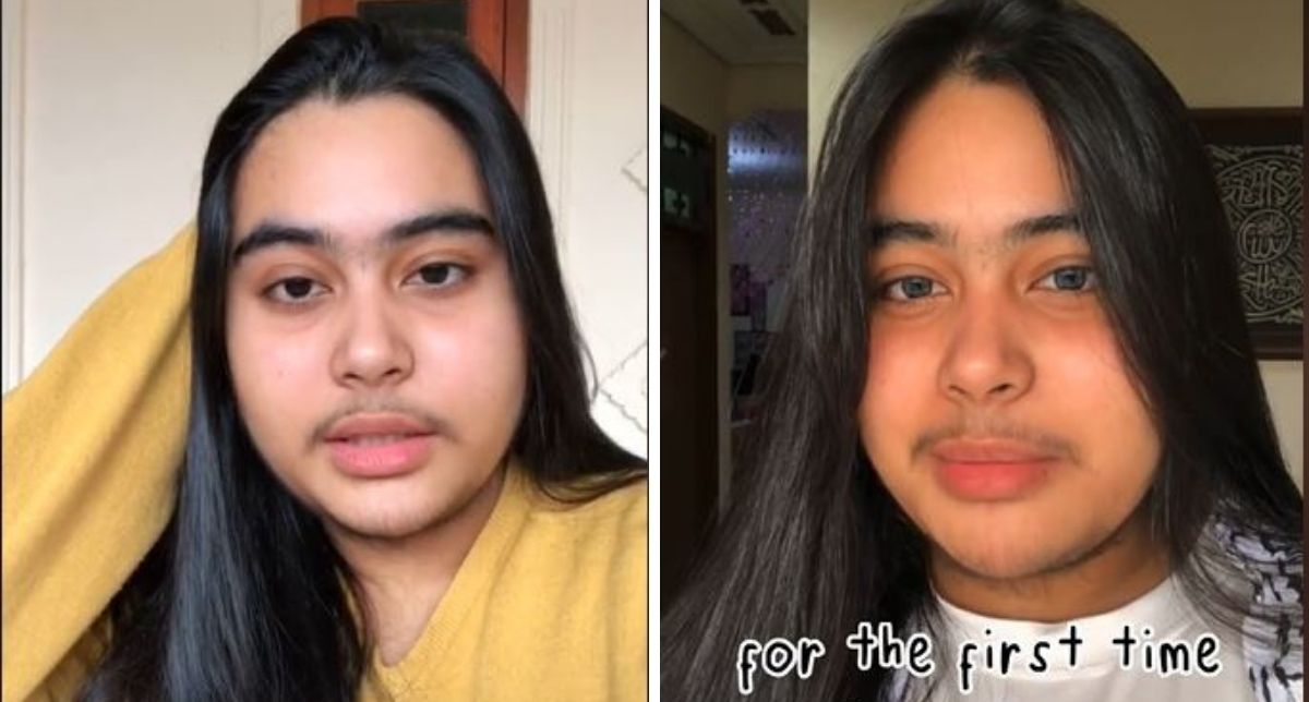 Gadis Bermisai &#038; Berbulu Tebal Viral Di TikTok, Kenali Sindrom Hirsutism