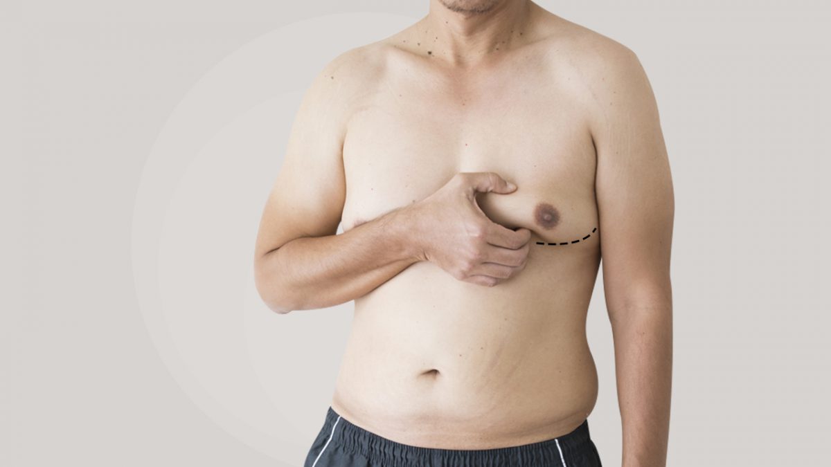 Masalah Payudara Besar Kepada Lelaki Ini Punca Sebenar Gynecomastia Remaja
