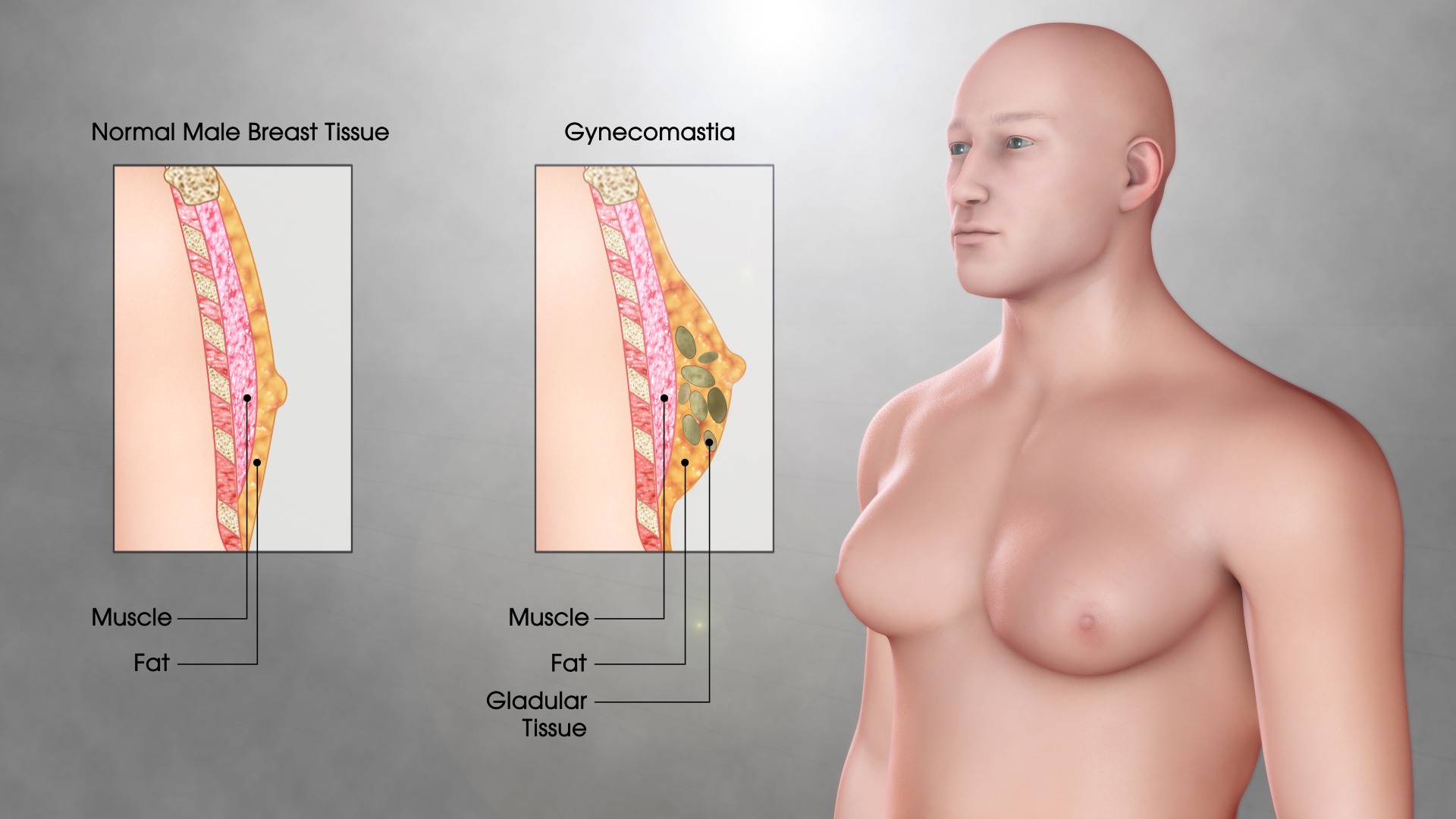 Masalah Payudara Besar Kepada Lelaki, Ini Punca Sebenar Gynecomastia