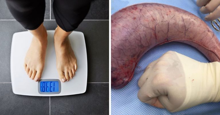 Pembedahan Pintasan Perut Untuk Cepat Kurus, Ini Hukum Yang Korang Perlu Tahu