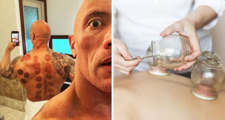 ‘The Rock’ Lakukan Terapi Bekam, 4 Kebaikan Kaedah Ini Untuk Tubuh Badan